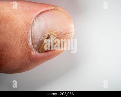 Infections des ongles causées par des champignons tels que: Onychomycose également connu sous le nom de tinea unguium. Infection du pouce Banque D'Images