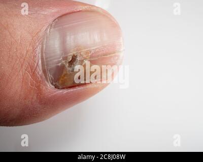 Infections des ongles causées par des champignons tels que: Onychomycose également connu sous le nom de tinea unguium. Infection du pouce Banque D'Images