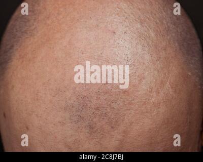 Concept de perte de cheveux humains. Gros plan avec une tête d'homme chauve avec alopécie. Banque D'Images