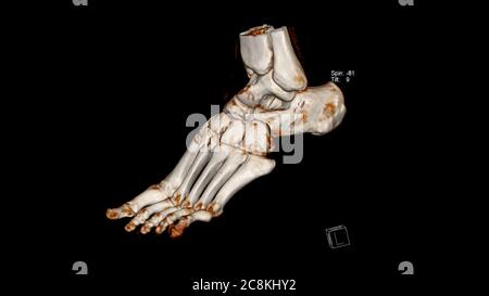 Tomodensitométrie Volume Rendering examen du pied ( CT VR foot) . Rendu 3D Banque D'Images