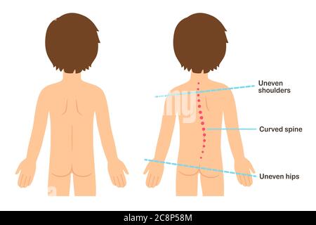 Infographie sur les signes de scoliose chez les enfants. Enfant avec un dos sain et une colonne vertébrale incurvée avec des épaules et des hanches inégales. Clip art vectoriel de style dessin animé plat i Illustration de Vecteur