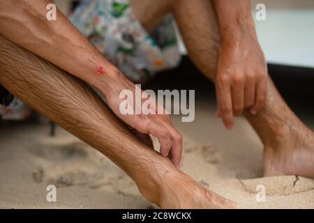 Le gars a eu des abrasions après une chute infructueuse du surf. Un gars mouillé sur la rive examine un bras blessé Banque D'Images