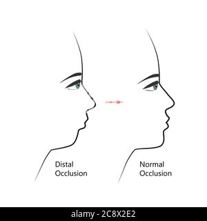 Profil distal de la morsure avant et après un traitement orthodontique. Humain présentant une malocclusion, une mâchoire inférieure repoussant, une correction de morsure par des accolades. Vecteur Illustration de Vecteur