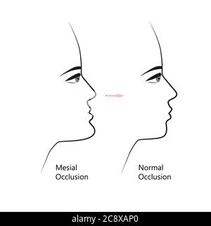 Profil de morsure mésiale avant et après un traitement orthodontique. Humain présentant une malocclusion, mâchoire inférieure étendue vers l'avant, correction des morsures par les accolades. Vecteur Illustration de Vecteur