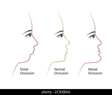 Profil de morsure distal, normal et mésial, illustration vectorielle. Surpiqûres ou sous-morsures avant et après un traitement orthodontique. Humain avec malocclusion Illustration de Vecteur