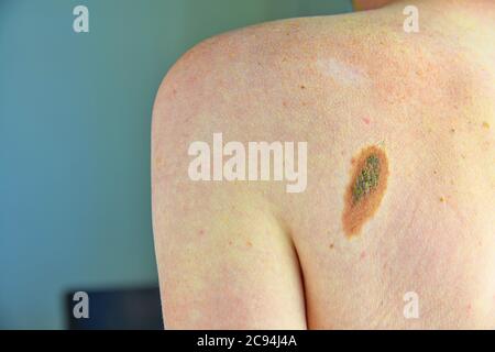 Mole de peau velue. Gros plan de nevus brun dangereux sur la peau humaine - mélanome Banque D'Images