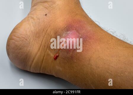 Des abcès se forment après les bactéries. Plaie ouverte purulente infectée sur le pied de l'homme. Banque D'Images