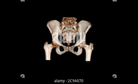 Tomodensitométrie Volume Rendering examen des os pelviens ( CT VR pelviens Bones). Rendu 3D Banque D'Images