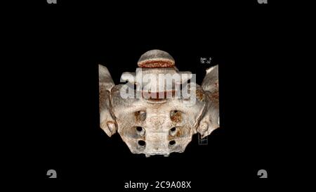 Tomodensitométrie rendu volumique examen des articulations sacro-iliaques (articulations sacro-iliaques CT VR). Rendu 3D Banque D'Images