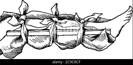 S bande de matériau rigide utilisée pour soutenir et immobiliser un os brisé lorsqu'il a été mis en place, dessin de ligne vintage ou illustration de gravure. Illustration de Vecteur