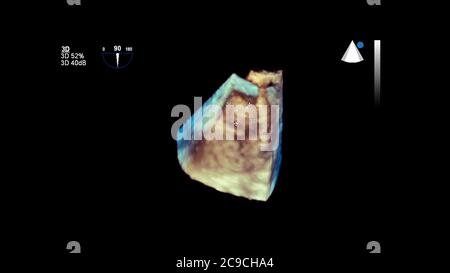 Image 3D du cœur pendant l'échographie transœsophagienne du cœur. Banque D'Images