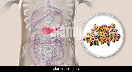 Pancréas humain et vue rapprochée de la molécule d'insuline, illustration informatique. Banque D'Images