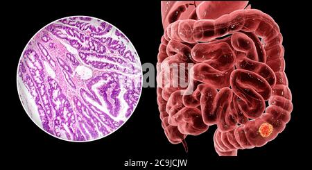 Cancer du côlon, illustration informatique et micrographe lumineux montrant l'adénocarcinome du côlon. Banque D'Images