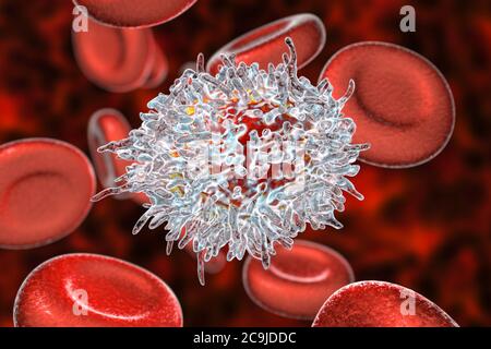 Leucémie à cellules poilues. Illustration informatique d'une cellule blanche anormale (lymphocytes B) d'un patient atteint de leucémie à cellules poilues. Ces cellules s'affichent Banque D'Images