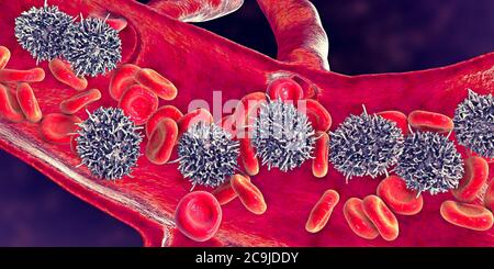 Leucémie à cellules poilues. Illustration informatique d'une anomalie des globules blancs (lymphocytes B) chez un patient atteint de leucémie à cellules poilues. Ces cellules sh Banque D'Images