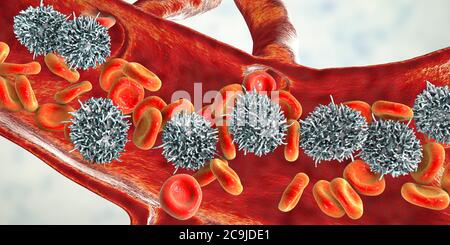 Leucémie à cellules poilues. Illustration informatique d'une anomalie des globules blancs (lymphocytes B) chez un patient atteint de leucémie à cellules poilues. Ces cellules sh Banque D'Images