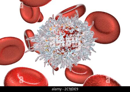 Leucémie à cellules poilues. Illustration informatique d'une cellule blanche anormale (lymphocytes B) d'un patient atteint de leucémie à cellules poilues. Ces cellules s'affichent Banque D'Images