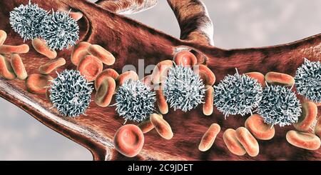 Leucémie à cellules poilues. Illustration informatique d'une anomalie des globules blancs (lymphocytes B) chez un patient atteint de leucémie à cellules poilues. Ces cellules sh Banque D'Images