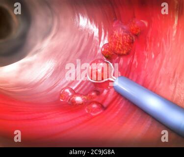 Retrait du polype, illustration. Retrait d'un polype colique avec une boucle de fil électrique pendant une coloscopie. Banque D'Images