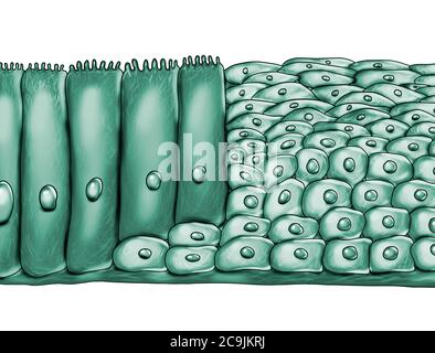 La métaplasie épithéliale, illustration de l'ordinateur. La métaplasie est un changement de type de cellule dans une région. Cette illustration montre une métaplasie spinocellulaire de respirat Banque D'Images