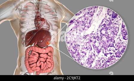 Adénocarcinome mucineux de l'estomac humain, illustration informatique et micrographe léger. Banque D'Images