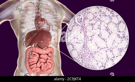 Adénocarcinome mucineux de l'estomac humain, illustration informatique et micrographe léger. Banque D'Images