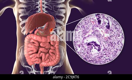 Adénocarcinome de l'estomac humain, illustration informatique et micrographe léger. Banque D'Images