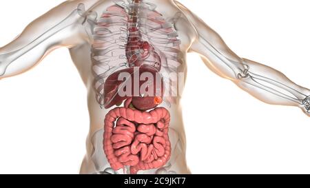 Le cancer de l'estomac humain, illustration de l'ordinateur. Banque D'Images