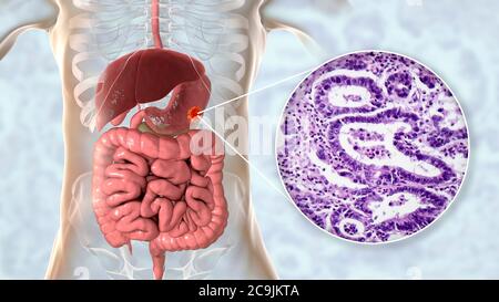 Adénocarcinome de l'estomac humain, illustration informatique et micrographe léger. Banque D'Images