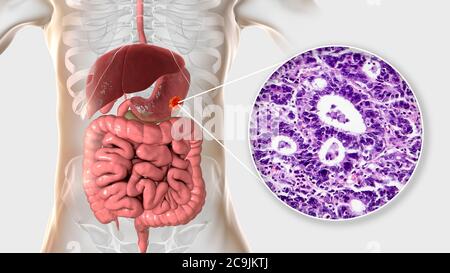 Adénocarcinome de l'estomac humain, illustration informatique et micrographe léger. Banque D'Images