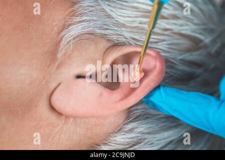 Auriculothérapie, ou traitement auriculaire sur l'oreille humaine avec un stylo de massage flexible en laiton, gros plan. Autocollant de pression d'acupuncture sur les graines d'oreille. Banque D'Images