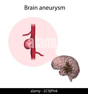 Anévrisme cérébral, illustration. Un anévrisme est une dilatation remplie de sang dans un vaisseau sanguin. Banque D'Images