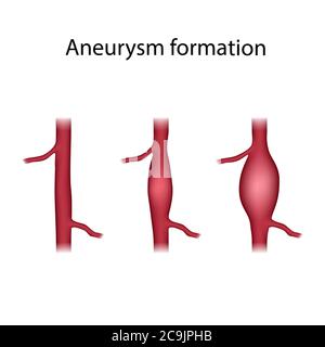 Formation d'anévrisme, illustration. Un anévrisme est une dilatation remplie de sang dans un vaisseau sanguin. Banque D'Images