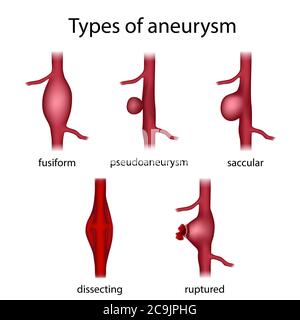 Types d'anévrisme, illustration. Un anévrisme est une dilatation remplie de sang dans un vaisseau sanguin. On voit ici le fusiforme, le pseudoanévrisme, le saccular, la dissectine Banque D'Images