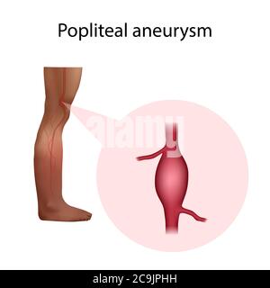 Anévrisme poplité, illustration. Un anévrisme est une dilatation remplie de sang dans un vaisseau sanguin. Banque D'Images