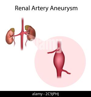 Anévrisme de l'artère rénale, illustration. Un anévrisme est une dilatation remplie de sang dans un vaisseau sanguin. Banque D'Images