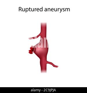 Rupture d'anévrisme, illustration. Un anévrisme est une dilatation remplie de sang dans un vaisseau sanguin. Banque D'Images