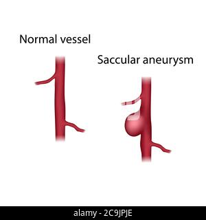 Comparaison des vaisseaux normaux et des anévrismes saccilaires, illustration. Un anévrisme est une dilatation remplie de sang dans un vaisseau sanguin. Banque D'Images