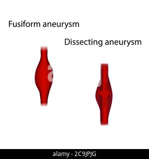 Comparaison d'anévrisme fusiforme et disséquante, illustration. Un anévrisme est une dilatation remplie de sang dans un vaisseau sanguin. Banque D'Images