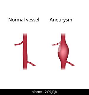 Comparaison des vaisseaux normaux et des anévrismes, illustration. Un anévrisme est une dilatation remplie de sang dans un vaisseau sanguin. Banque D'Images