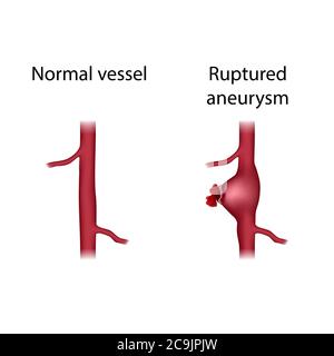 Comparaison des vaisseaux normaux et des anévrismes rompus, illustration. Un anévrisme est une dilatation remplie de sang dans un vaisseau sanguin. Banque D'Images