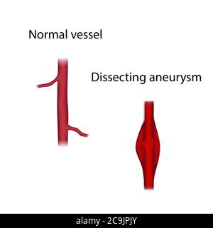 Comparaison des vaisseaux normaux et des anévrismes disséquant, illustration. Un anévrisme est une dilatation remplie de sang dans un vaisseau sanguin. Banque D'Images