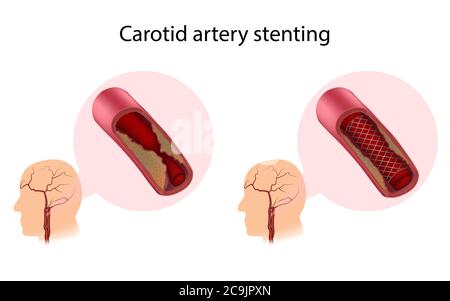 Stent de l'artère carotide, avant et après la chirurgie, illustration Banque D'Images