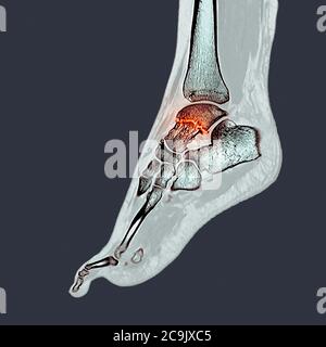 Fracture de l'os de la cheville. Tomodensitométrie colorée (CT) des os du pied et de la cheville d'une femme de 23 ans avec une comminée (fracturée) Banque D'Images