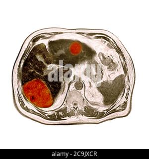 Cancer du foie. Tomodensitométrie axiale colorée (CT) à travers l'abdomen d'un homme de 80 ans atteint d'un cancer du foie. Le foie est au centre Banque D'Images