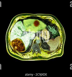 Cancer du foie. Tomodensitométrie axiale colorée (CT) à travers l'abdomen d'un homme de 80 ans atteint d'un cancer du foie. Le foie est au centre Banque D'Images