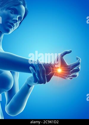 Femme avec une main douloureuse, illustration. Banque D'Images