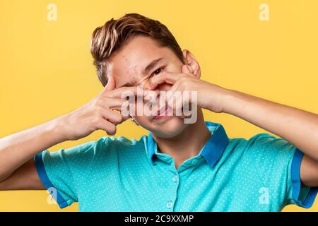 Cosmétologie, dermatologie et acné. Adolescent de race blanche dans un t-shirt bleu, tire douloureusement un bouton sur son nez. Arrière-plan jaune. Gros plan. Banque D'Images