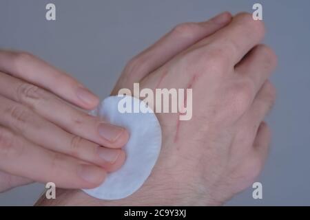 Vue rapprochée de la main d'homme essayant de traiter les rayures de chat avec un tampon de coton et du peroxyde d'hydrogène. Premiers soins, soins de santé, traitement et médecine concept Banque D'Images