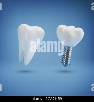 Vecteur avec implant dentaire réaliste et dent saine sur fond bleu. 3d. Élément de conception, modèle de mise en page pour les cliniques dentaires Banque D'Images